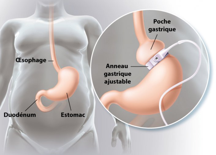 anneau-gastrique-tunisie