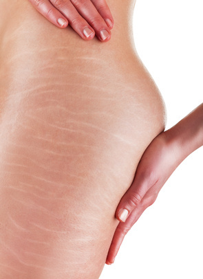 Traitement de la cellulite